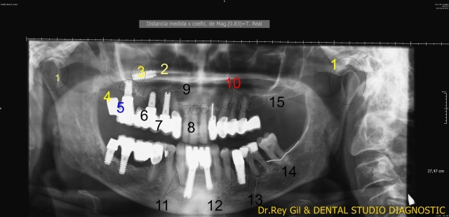 Implantes dentales Valladolid Dr Rey Gil. Complicaciones en implantes dentales. 